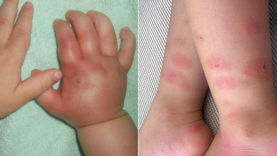 Уход за детьми :: На что у грудного ребенка бывает аллергия. Симптомы и лечение
