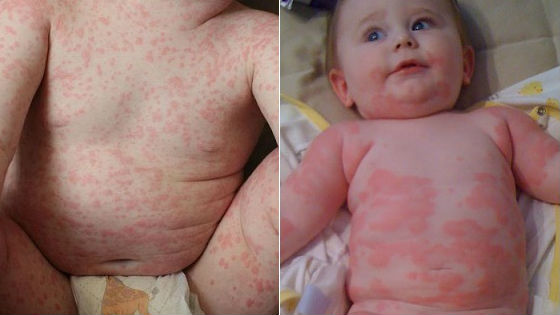Уход за детьми :: На что у грудного ребенка бывает аллергия. Симптомы и лечение