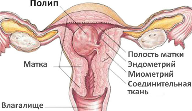 Интимное здоровье :: Удаление полипа эндометрия: методы, противопоказания