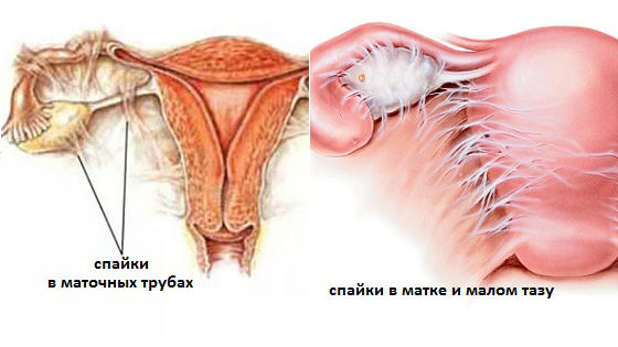 Интимное здоровье :: Спайки в маточных трубах: причины образования, диагностика и лечение