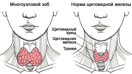 Болезни :: Виды узлового зоба щитовидной железы, симптомы и лечение