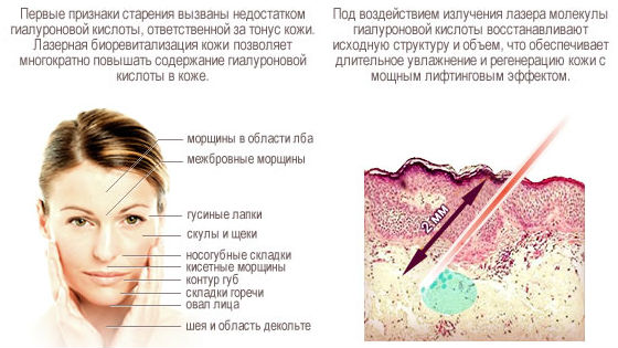 Косметология :: Лазерное омоложение лица: виды, эффективность, видео, описание процедуры