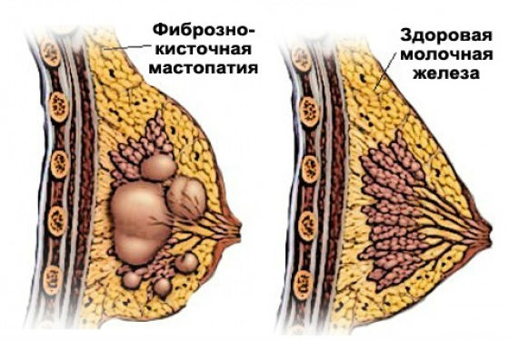 Как выглядят фиброзные узлы в женской груди