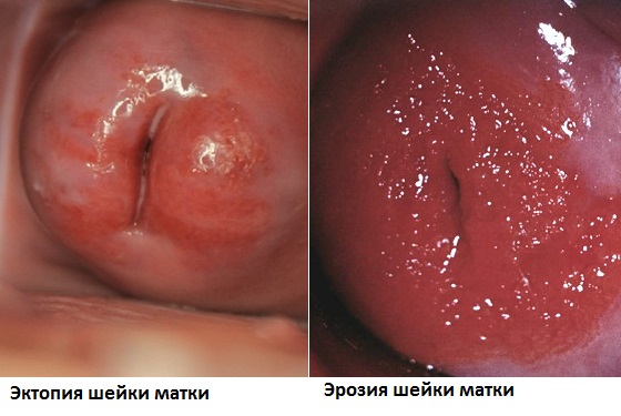 эктопия и эрозия шейки матки