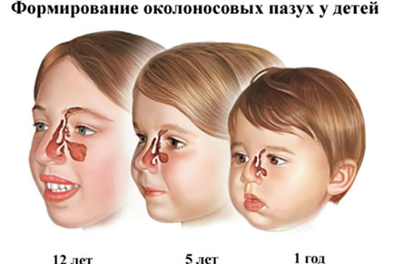 Синусит у детей воспаление пазух носа у 25 Синусит у детей воспаление пазух носа у 89