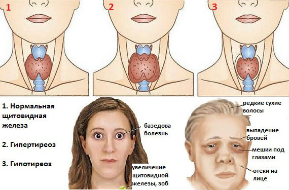 Отклонения в работе щитовидки