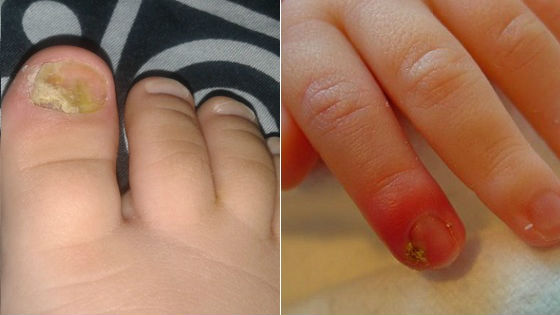Уход за детьми :: Почему слоятся ногти у ребенка. Лечение и восстановление ногтевой пластины