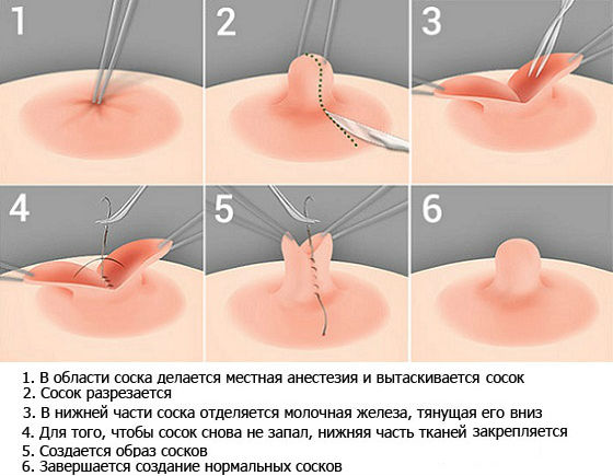 Болезни :: Какие соски называют втянутыми. Виды, последствия, способы коррекции