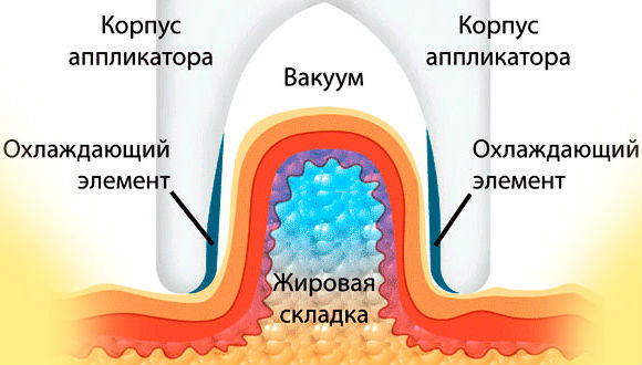 Косметология :: Криолиполиз: что это такое, как проводится. Достоинства и недостатки, показания и противопоказания