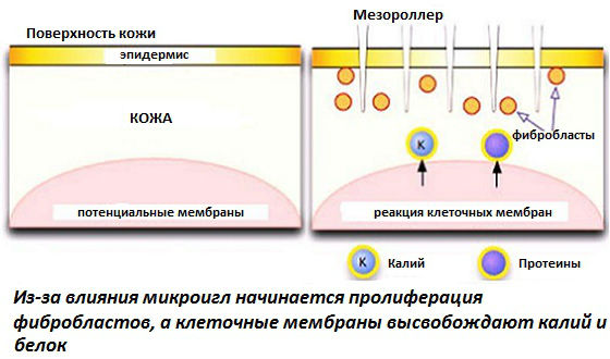 Принцип действия дерматороллера на кожу