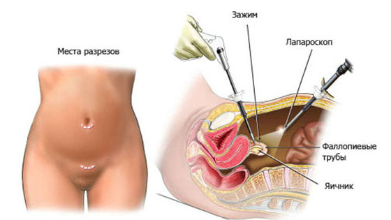 Интимное здоровье :: Лапароскопия маточных труб: как проводится, преимущества и недостатки