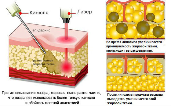 Косметология :: Лазерный липолиз: описание метода, преимущества и недостатки, противопоказания
