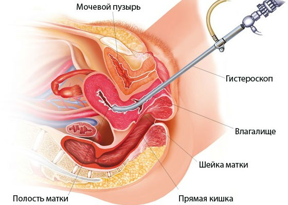 Как проводится диагностика с использованием гистероскопа