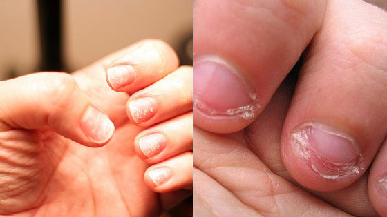 Уход за детьми :: Почему слоятся ногти у ребенка. Лечение и восстановление ногтевой пластины