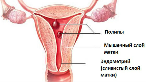 Разновидности выростов на слизистой матки