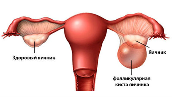 Фолликулярная киста или беременность