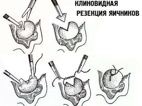 Клиновидное удаление части яичника