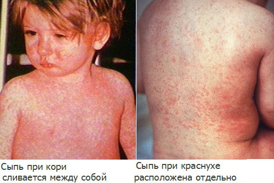 Высыпание при кори фото у детей Высыпание при кори фото у детей