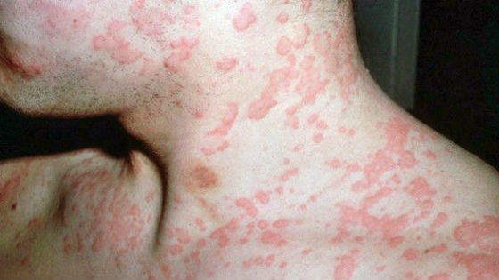 Фото заболеваний кожи у ребенка 81 Фото заболеваний кожи у ребенка 63