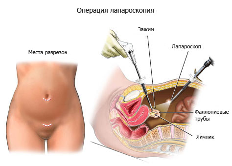 Лапароскопия