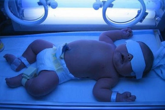Фототерапия для ускоренного выведения билирубина из организма