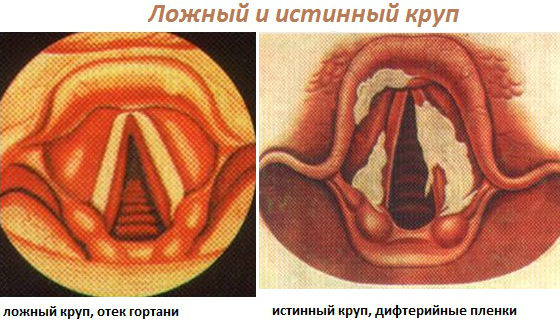 Уход за детьми :: Ложный круп у детей. Первая помощь при стенозе гортани