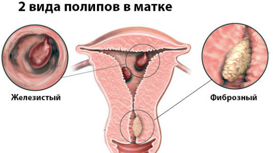 Полип на шейке матки при беременности на ранних сроках