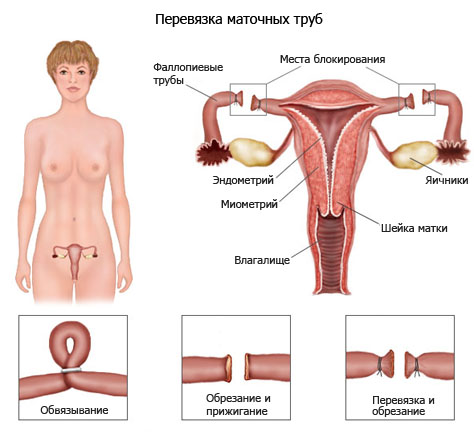 Методы перевязки маточных труб
