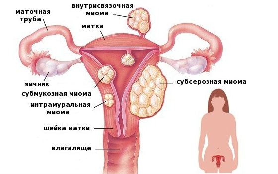 Розовые выделения у женщин: причины, норма, патология, когда обратиться к врачу