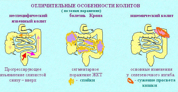 Виды и формы воспаления кишечника
