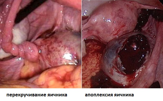 Патологии, при которых тянет яичник справа