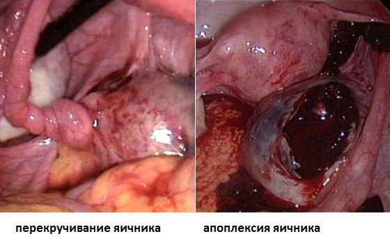 Интимное здоровье :: Болит правый яичник: возможные причины, особенности в разном возрасте, лечение