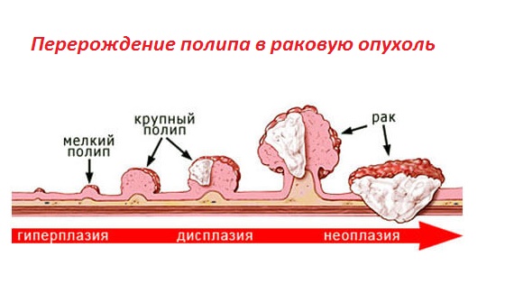 Перерождение полипов в раковую опухоль