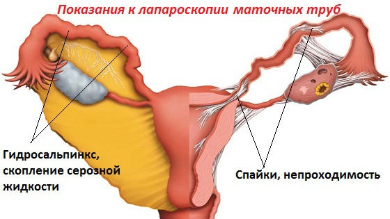 Показания к лапароскопическому обследованию и проведению операции