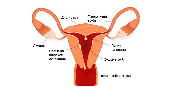 Полип эндометрия как лечить без операции отзывы Полип эндометрия как лечить без операции отзывы