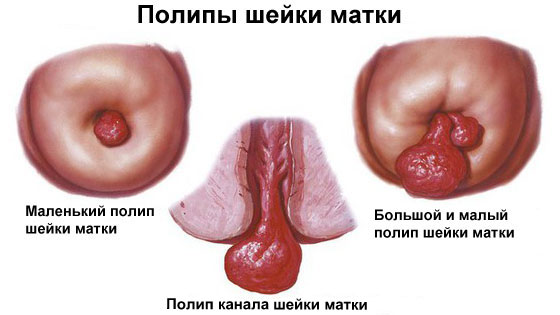Эндометриоз причины симптомы и лечение. Как лечить эндометриоз