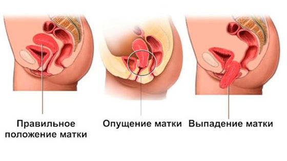 опущение матки симптомы и фото онлайн опущение матки симптомы и фото