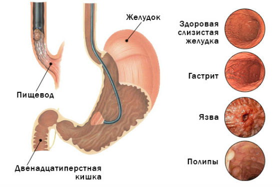 Уход за детьми :: Гастрит у детей: причины, симптомы и лечение, формы и диагностика