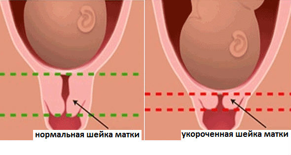 Что такое зев в гинекологии