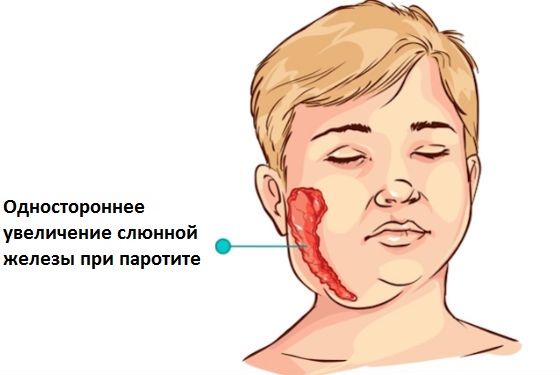 Воспаление и увеличение слюнных желез при паротите