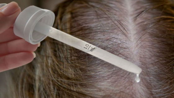 Уход за волосами :: Препараты миноксидила для восстановления волос при облысении