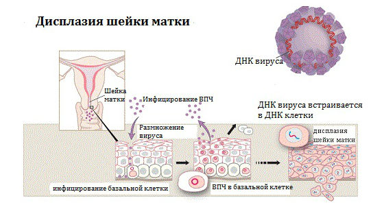 Как лечить дисплазию шейки матки 1 степени отзывы Как лечить дисплазию шейки матки 1 степени отзывы