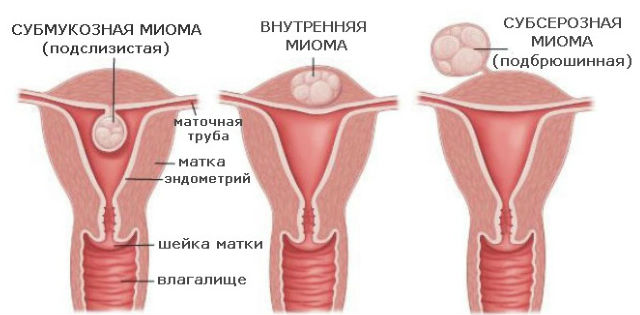 Как проходит операция по удалению миомы матки Твой гинеколог