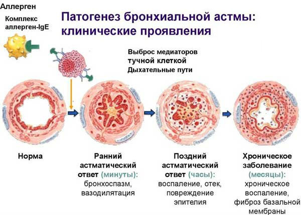 Процесс развития спазма бронхов при приступе