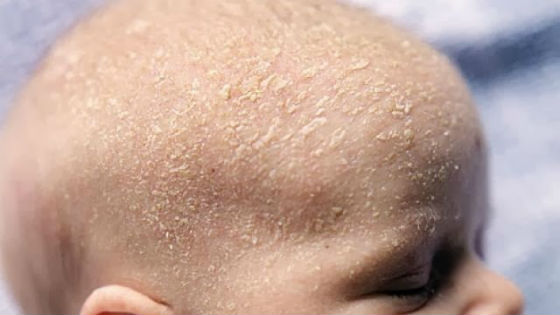 Лечим кожу головы шелушится Лечим кожу головы шелушится