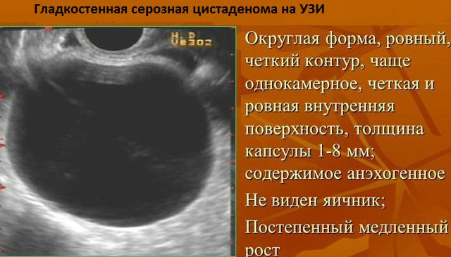 Затемнения на УЗИ при патологических образованиях