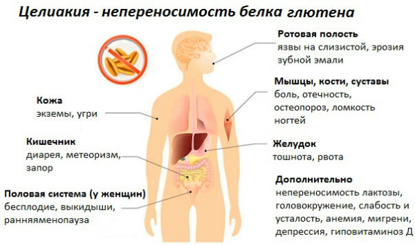 Основные признаки непереносимости глютена