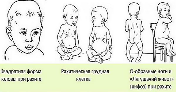 Признаки недостатка витамина д у грудничков