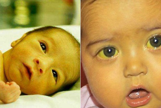 Уход за детьми :: Опасные и неопасные причины желтухи у новорожденных. Симптомы, диагностика и лечение разных форм