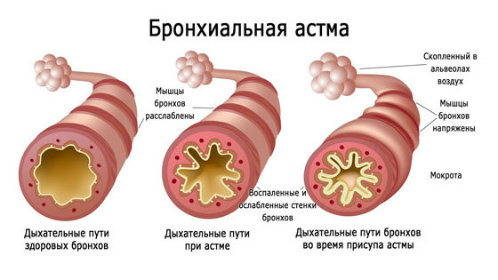 Бронхи нормальные и при спазме